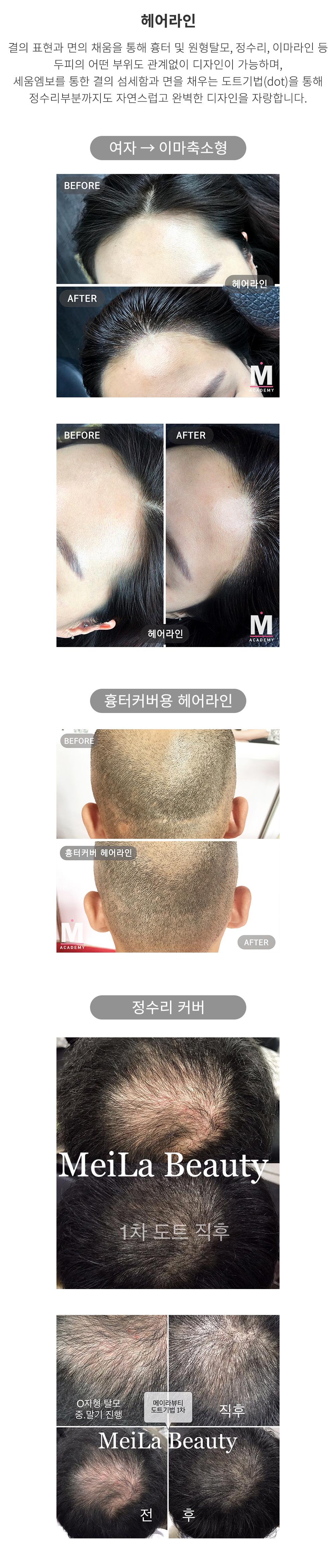 헤어라인
